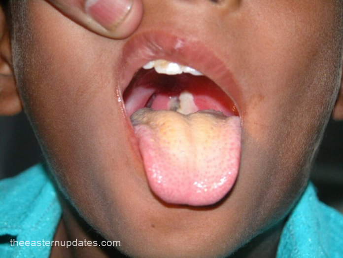 Enugu State health officials reviewing a suspected diphtheria case